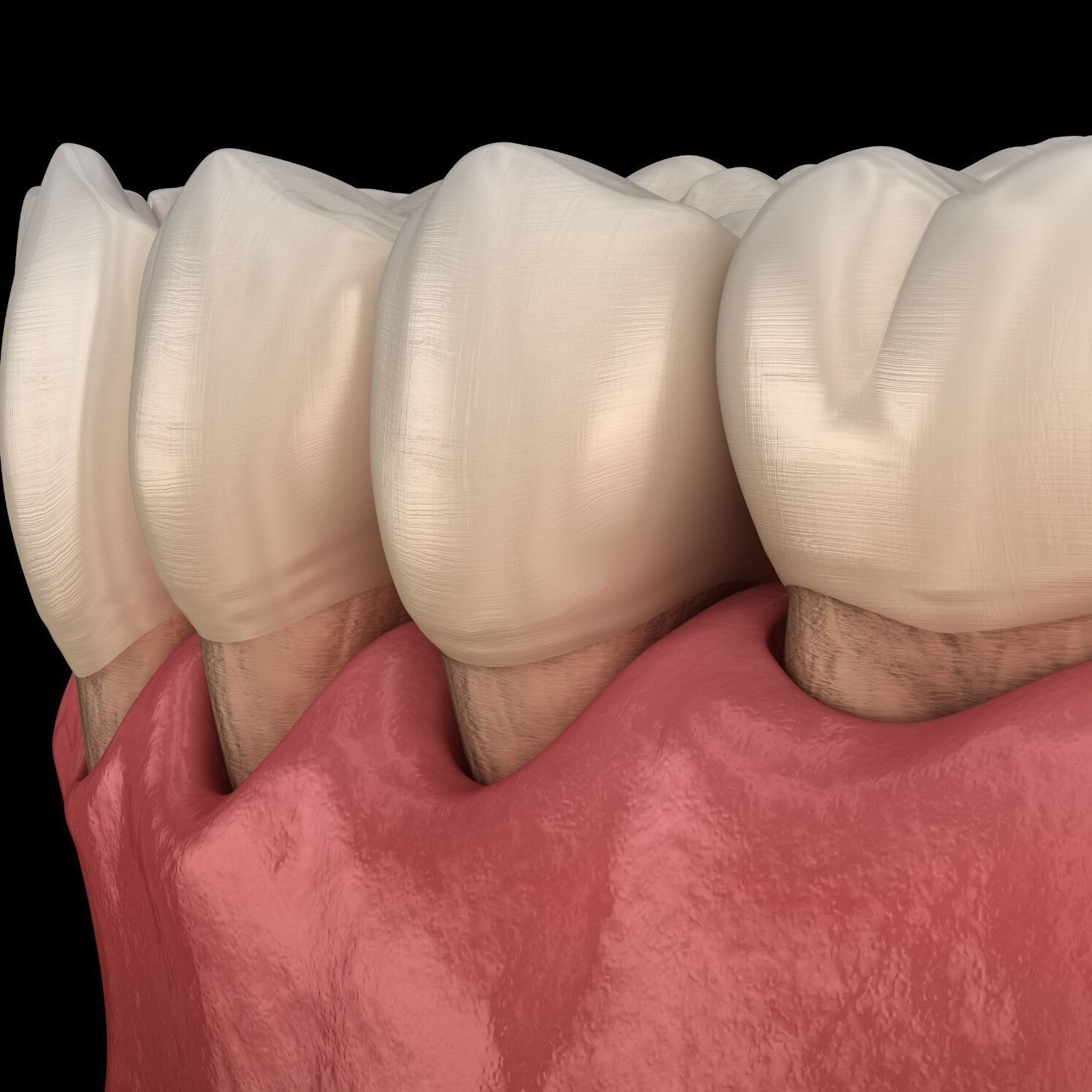Close up shot on a model of teeth showing gum disease